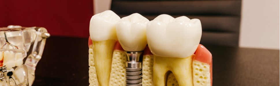 INTELIGENTNE IMPLANTY DENTYSTYCZNE ODPORNE NA ROZWÓJ BAKTERII