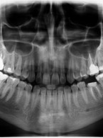 Zabieg implantacji natychmiastowej w żuchwie przeprowadzony przy użyciu nawigacji komputerowej i szablonu chirurgicznego